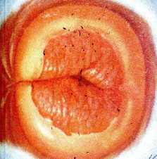 Big erosion showing abnormal pap smear (CIN- II) .